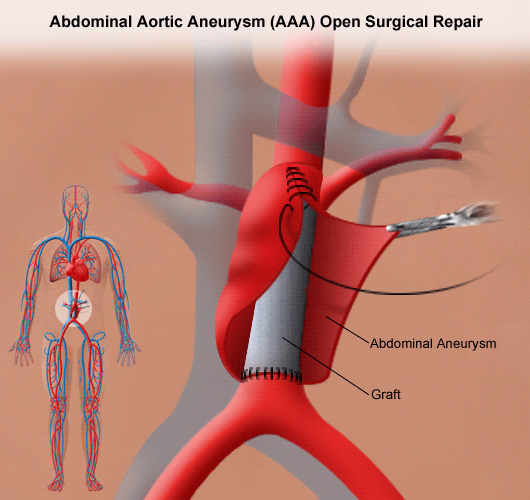 abd AAA_Open_Repair